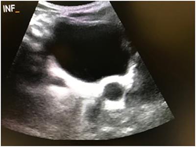 Primary Non-refluxing Megaureter: Analysis of Risk Factors for Spontaneous Resolution and Surgical Intervention